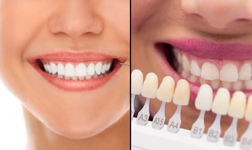 Veneers vs Teeth Whitening: Which One Is Right for You?
